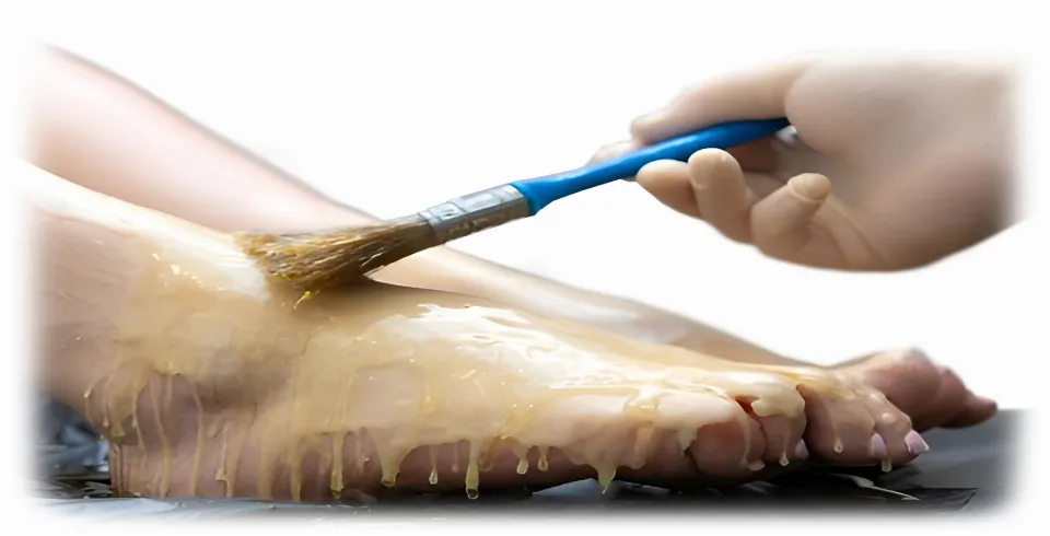 Парафинотерапия в Нафталане